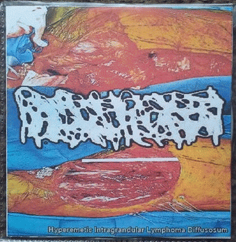 Hydrocephalus : Hyperemetic Intergrandual Lymphoma Diffusosum Hydrocephalus : Hyperemetic Intergrandual Lymphoma Diffusosum